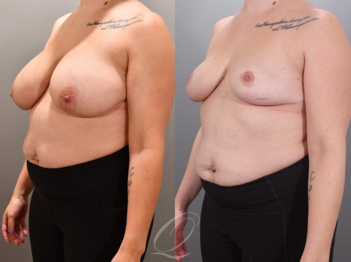 Breast Reduction Case 1001924 Before & After Left Oblique | Serving Rochester, Syracuse & Buffalo, NY | Quatela Center for Plastic Surgery