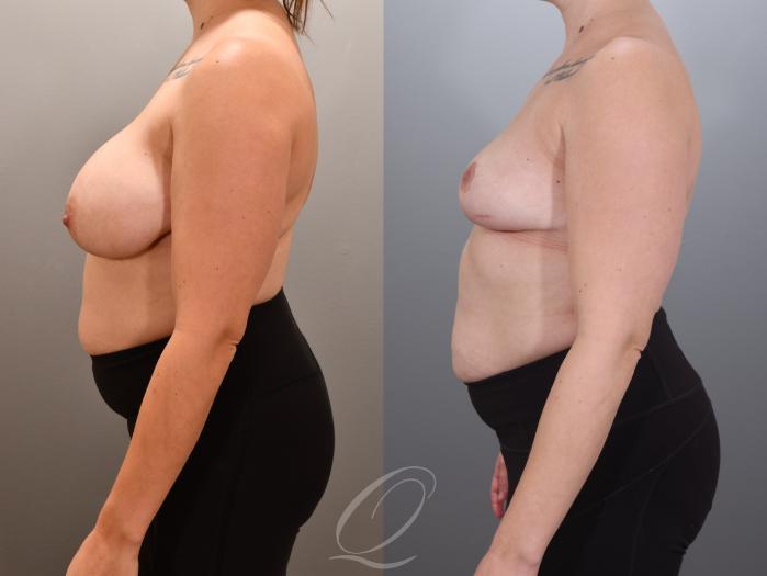 Breast Reduction Case 1001924 Before & After Left Side | Serving Rochester, Syracuse & Buffalo, NY | Quatela Center for Plastic Surgery