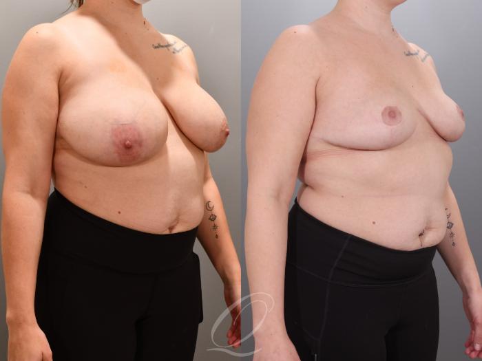 Breast Reduction Case 1001924 Before & After Right Oblique | Serving Rochester, Syracuse & Buffalo, NY | Quatela Center for Plastic Surgery