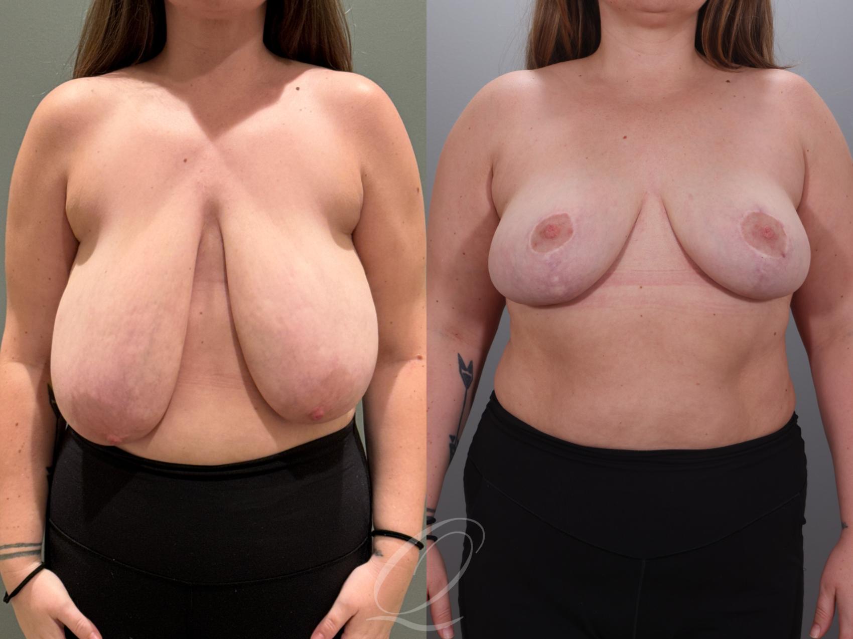 Breast Reduction Case 1001927 Before & After Front | Serving Rochester, Syracuse & Buffalo, NY | Quatela Center for Plastic Surgery