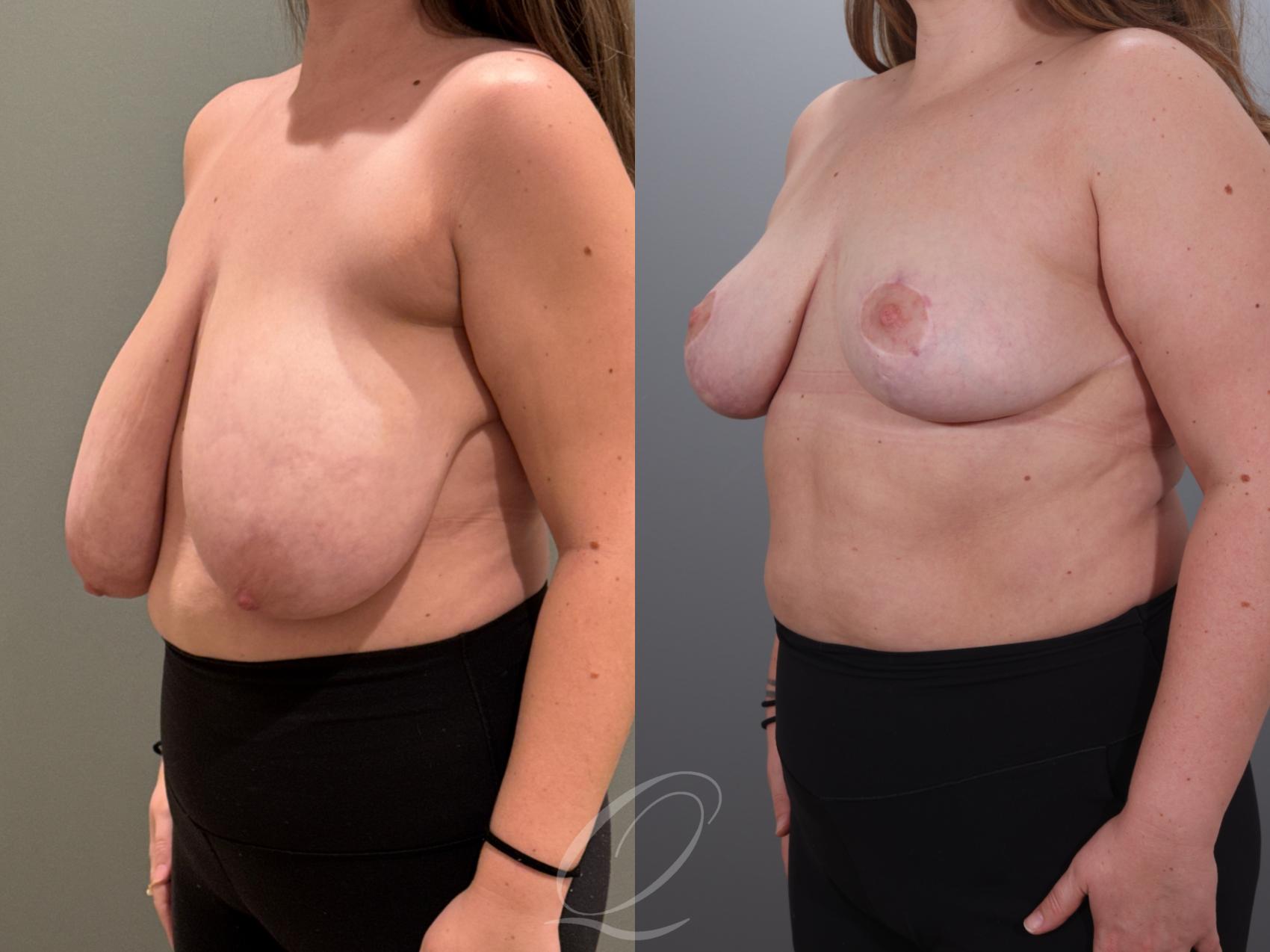 Breast Reduction Case 1001927 Before & After Left Oblique | Serving Rochester, Syracuse & Buffalo, NY | Quatela Center for Plastic Surgery