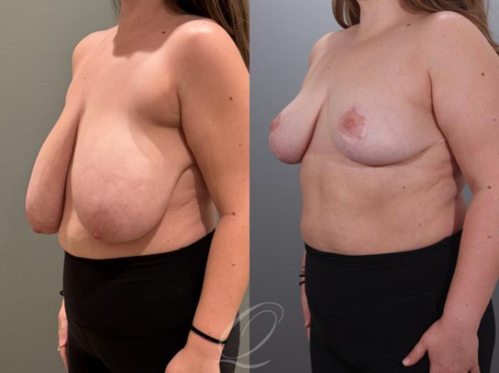 Breast Reduction Case 1001927 Before & After Left Oblique | Serving Rochester, Syracuse & Buffalo, NY | Quatela Center for Plastic Surgery