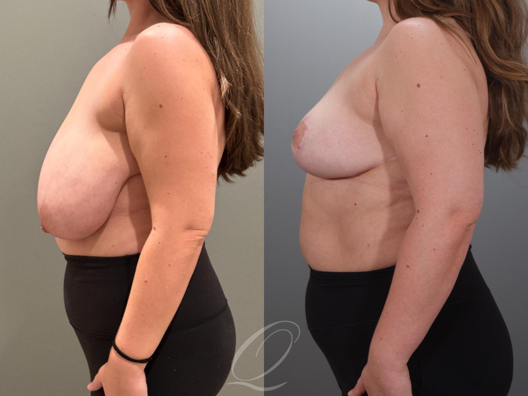 Breast Reduction Case 1001927 Before & After Left Side | Serving Rochester, Syracuse & Buffalo, NY | Quatela Center for Plastic Surgery