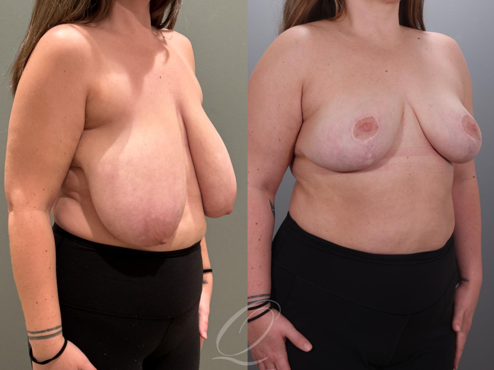 Breast Reduction Case 1001927 Before & After Right Oblique | Serving Rochester, Syracuse & Buffalo, NY | Quatela Center for Plastic Surgery