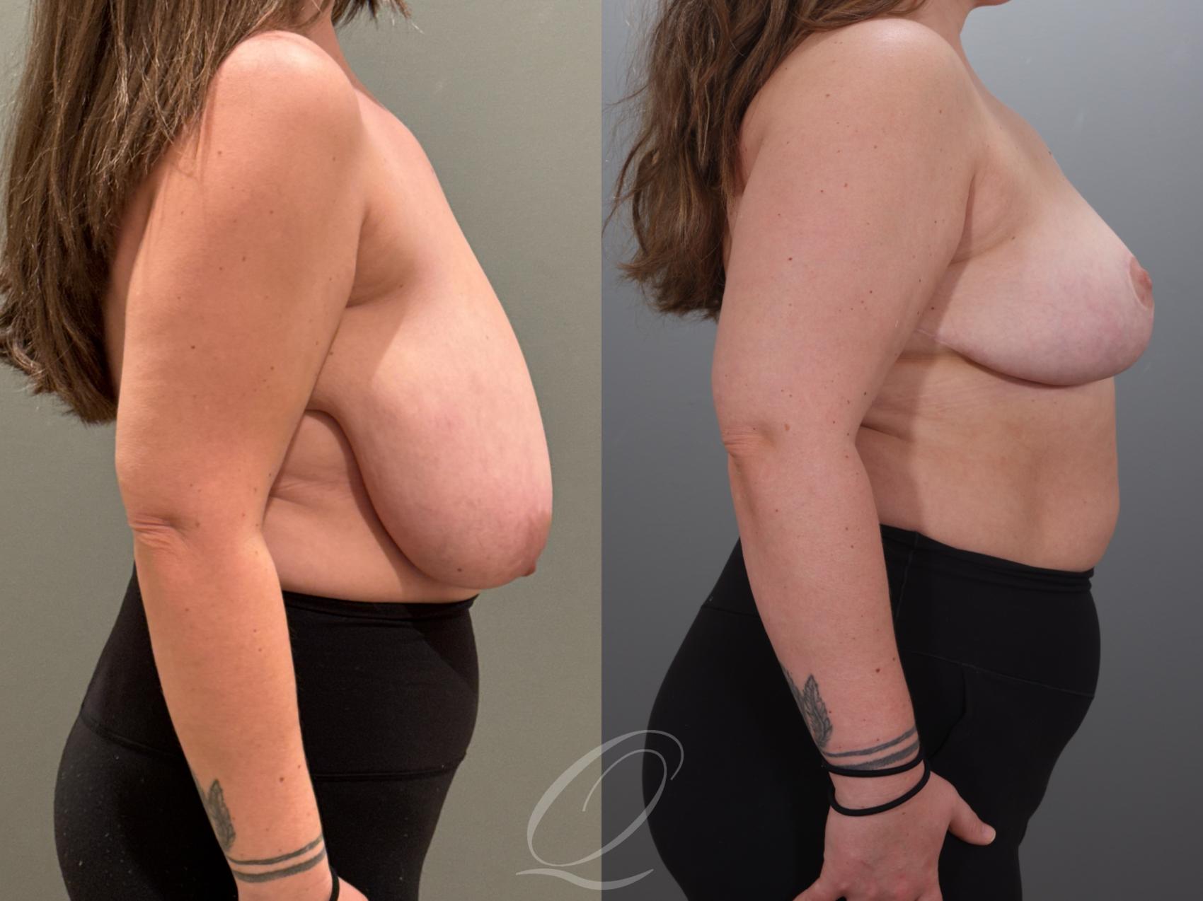 Breast Reduction Case 1001927 Before & After Right Side | Serving Rochester, Syracuse & Buffalo, NY | Quatela Center for Plastic Surgery
