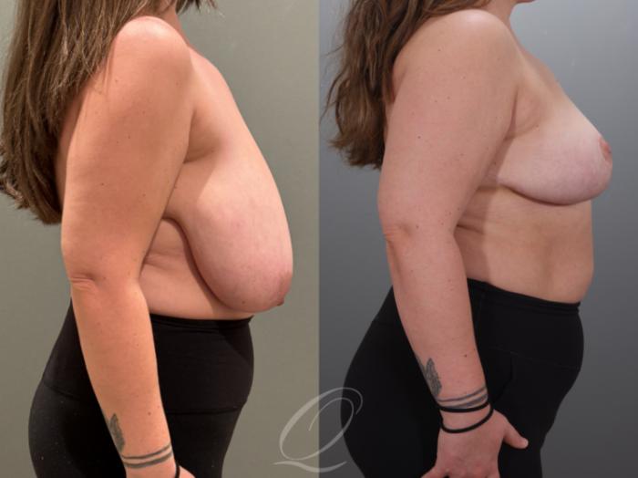Breast Reduction Case 1001927 Before & After Right Side | Serving Rochester, Syracuse & Buffalo, NY | Quatela Center for Plastic Surgery