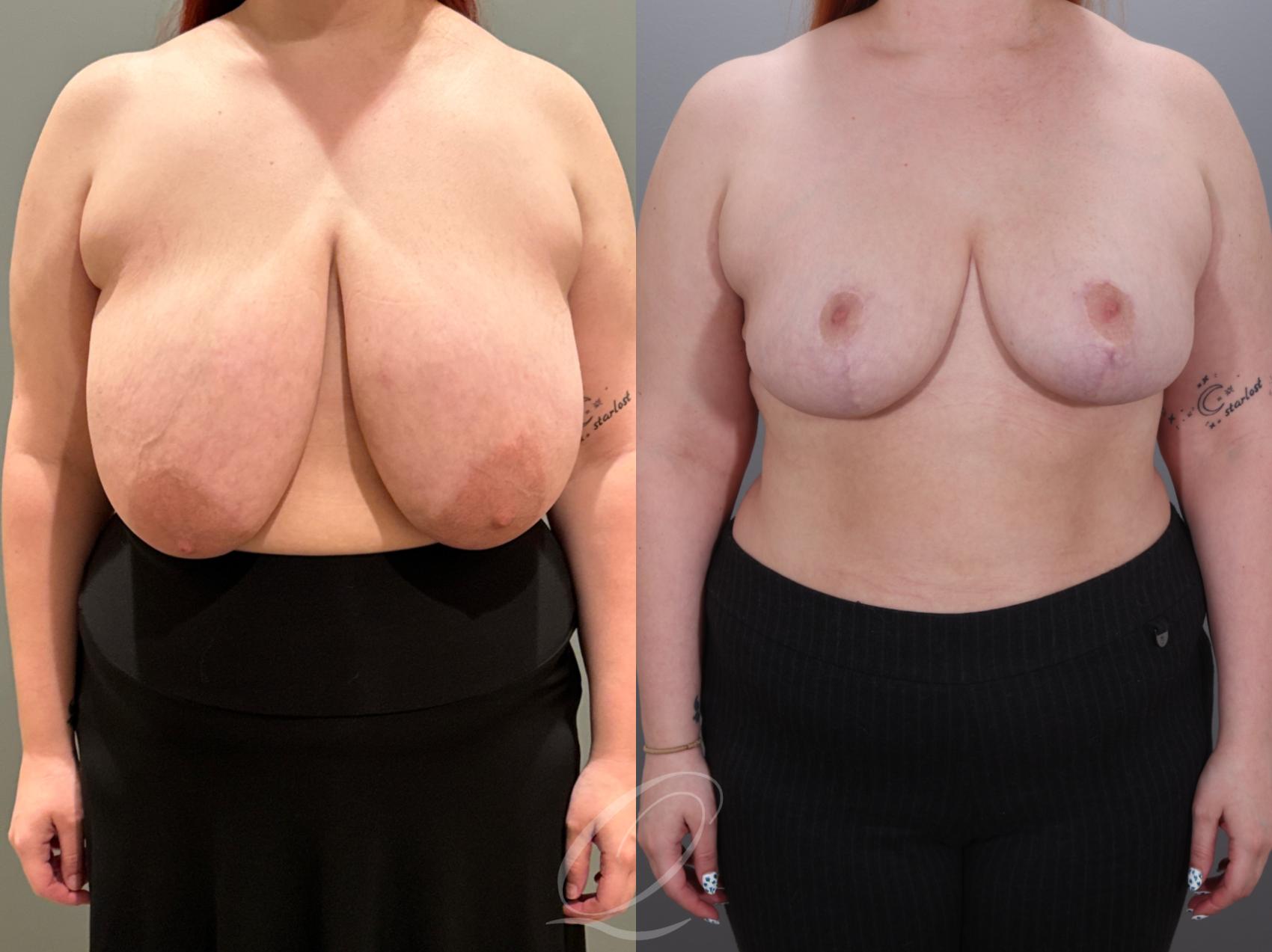 Breast Reduction Case 1001928 Before & After Front | Serving Rochester, Syracuse & Buffalo, NY | Quatela Center for Plastic Surgery