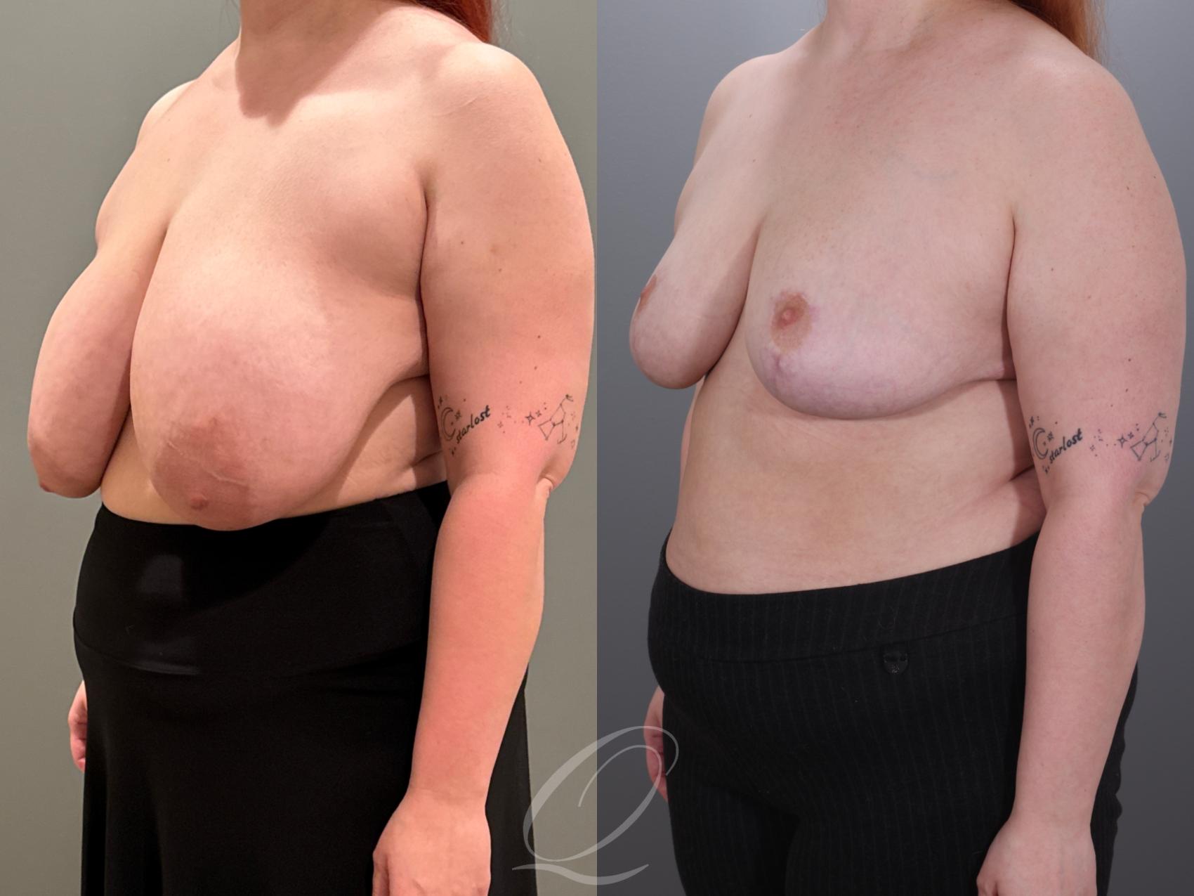 Breast Reduction Case 1001928 Before & After Left Oblique | Serving Rochester, Syracuse & Buffalo, NY | Quatela Center for Plastic Surgery