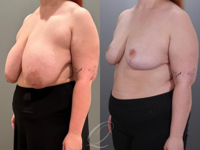 Breast Reduction Case 1001928 Before & After Left Oblique | Serving Rochester, Syracuse & Buffalo, NY | Quatela Center for Plastic Surgery