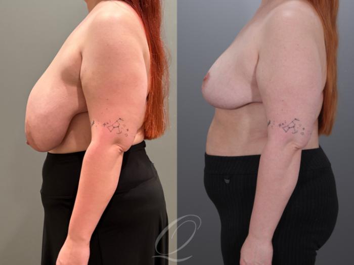 Breast Reduction Case 1001928 Before & After Left Side | Serving Rochester, Syracuse & Buffalo, NY | Quatela Center for Plastic Surgery