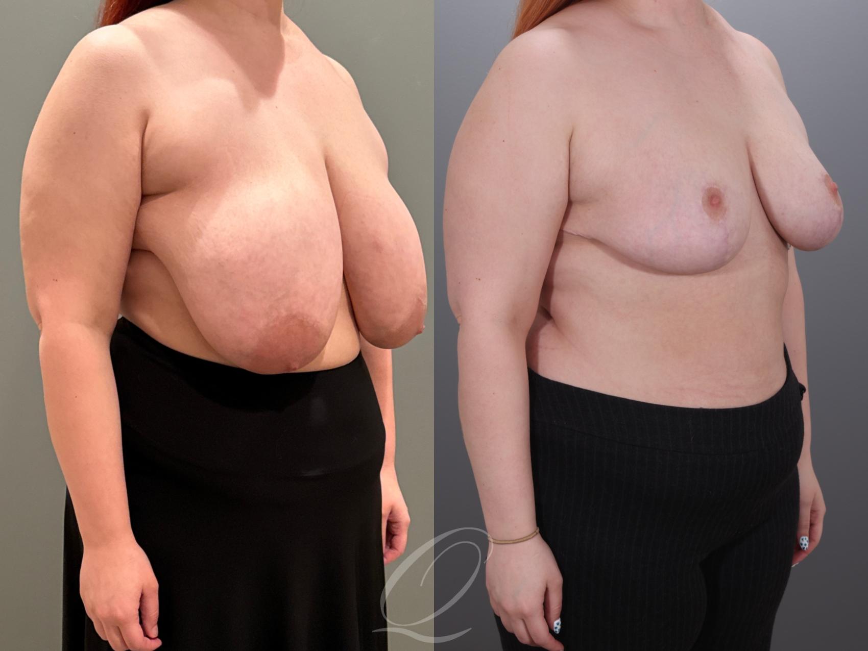 Breast Reduction Case 1001928 Before & After Right Oblique | Serving Rochester, Syracuse & Buffalo, NY | Quatela Center for Plastic Surgery