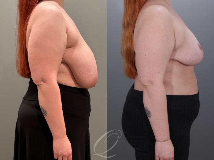 Breast Reduction Case 1001928 Before & After Right Side | Serving Rochester, Syracuse & Buffalo, NY | Quatela Center for Plastic Surgery