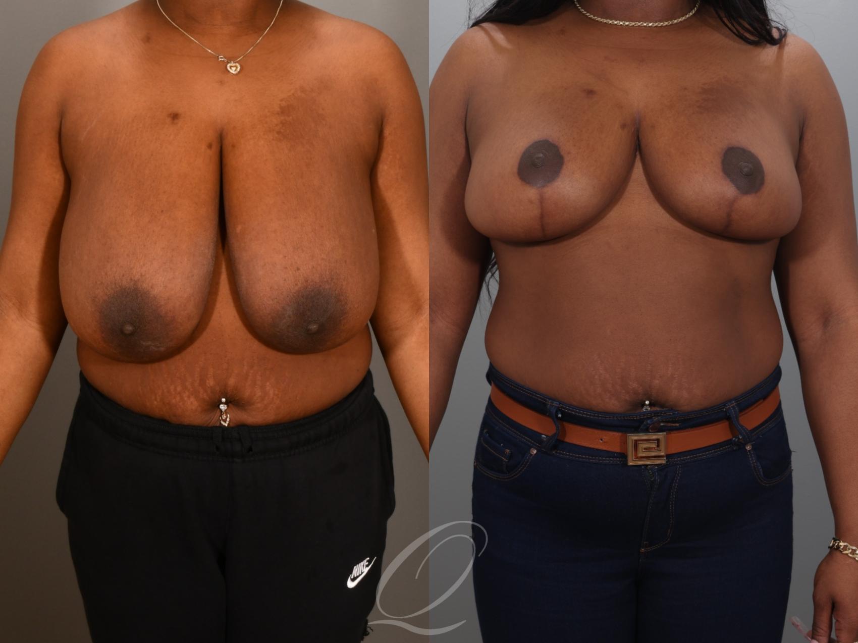 Breast Reduction Case 1001942 Before & After Front | Serving Rochester, Syracuse & Buffalo, NY | Quatela Center for Plastic Surgery