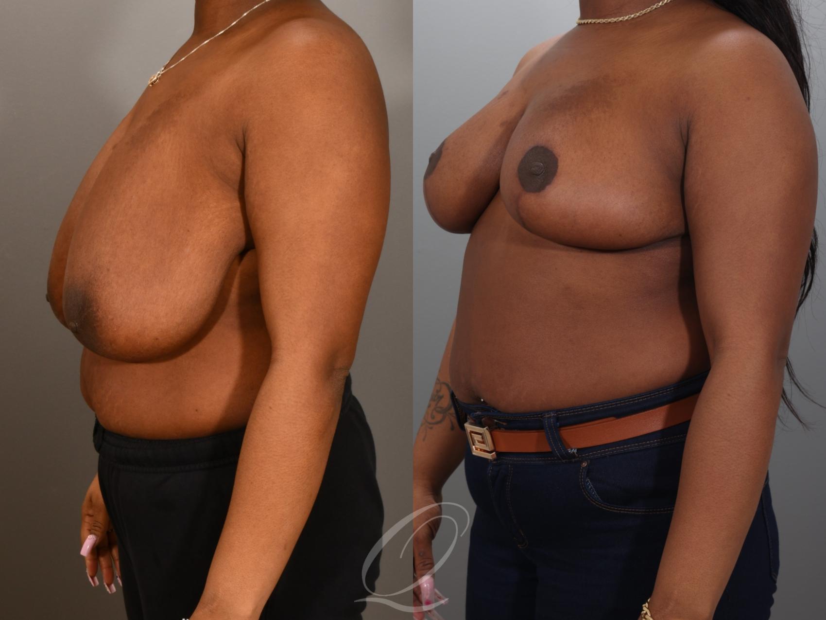 Breast Reduction Case 1001942 Before & After Left Oblique | Serving Rochester, Syracuse & Buffalo, NY | Quatela Center for Plastic Surgery