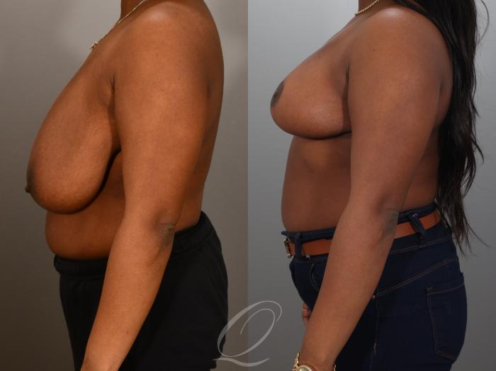 Breast Reduction Case 1001942 Before & After Left Side | Serving Rochester, Syracuse & Buffalo, NY | Quatela Center for Plastic Surgery