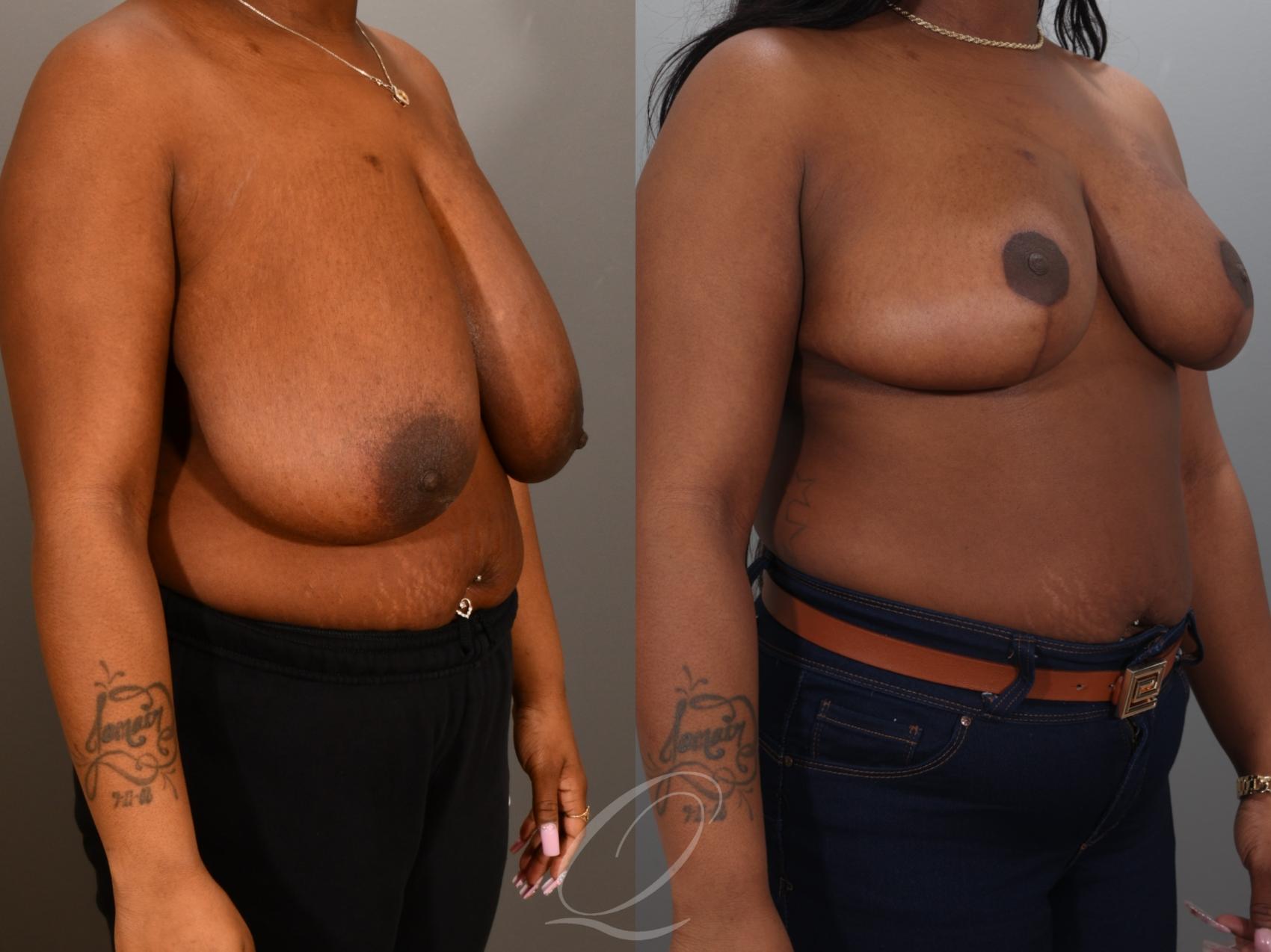 Breast Reduction Case 1001942 Before & After Right Oblique | Serving Rochester, Syracuse & Buffalo, NY | Quatela Center for Plastic Surgery