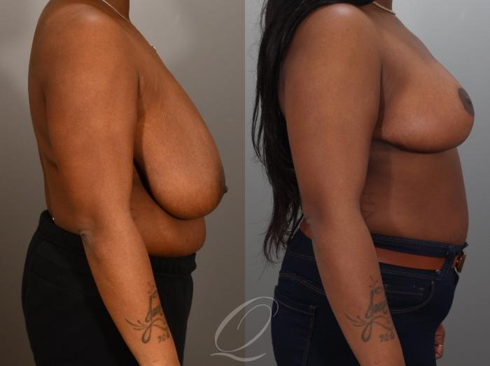 Breast Reduction Case 1001942 Before & After Right Side | Serving Rochester, Syracuse & Buffalo, NY | Quatela Center for Plastic Surgery