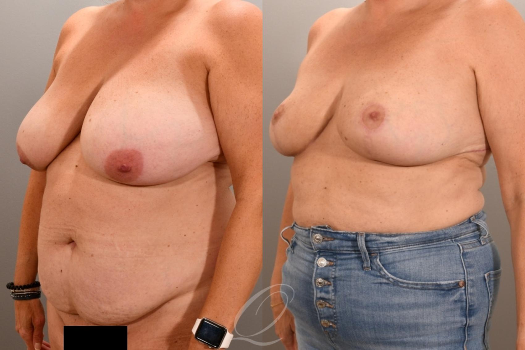 Breast Reduction Case 1001943 Before & After Left Oblique | Serving Rochester, Syracuse & Buffalo, NY | Quatela Center for Plastic Surgery