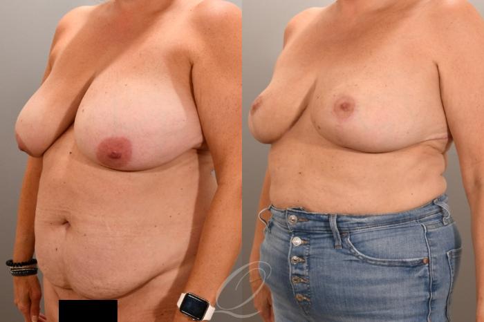 Breast Reduction Case 1001943 Before & After Left Oblique | Serving Rochester, Syracuse & Buffalo, NY | Quatela Center for Plastic Surgery
