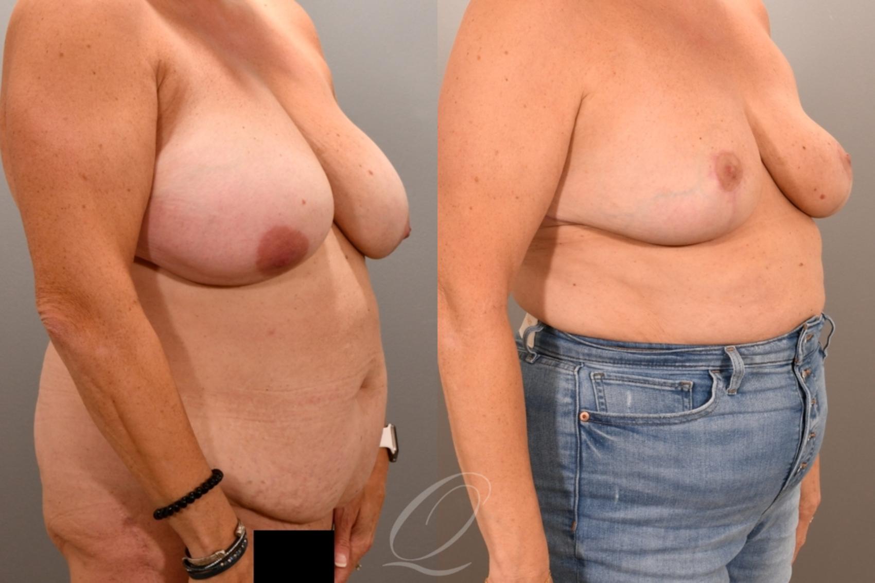 Breast Reduction Case 1001943 Before & After Right Oblique | Serving Rochester, Syracuse & Buffalo, NY | Quatela Center for Plastic Surgery