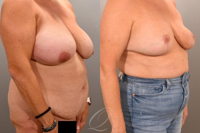 Breast Reduction Case 1001943 Before & After Right Oblique | Serving Rochester, Syracuse & Buffalo, NY | Quatela Center for Plastic Surgery