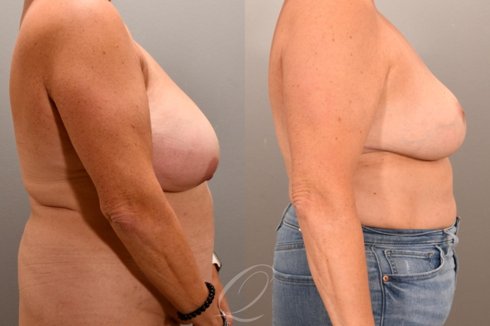 Breast Reduction Case 1001943 Before & After Right Side | Serving Rochester, Syracuse & Buffalo, NY | Quatela Center for Plastic Surgery