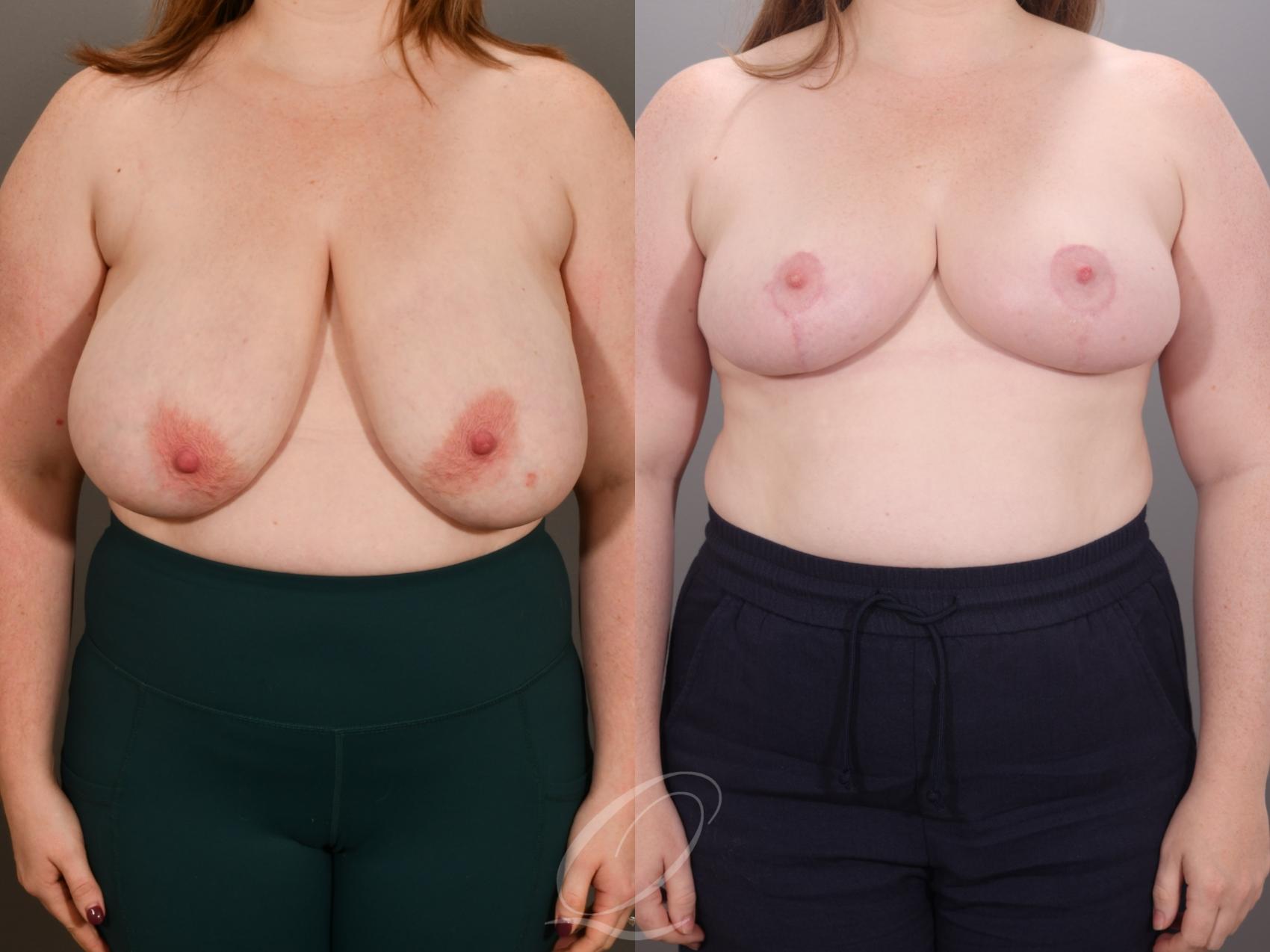 Breast Reduction Case 1001952 Before & After Front | Serving Rochester, Syracuse & Buffalo, NY | Quatela Center for Plastic Surgery