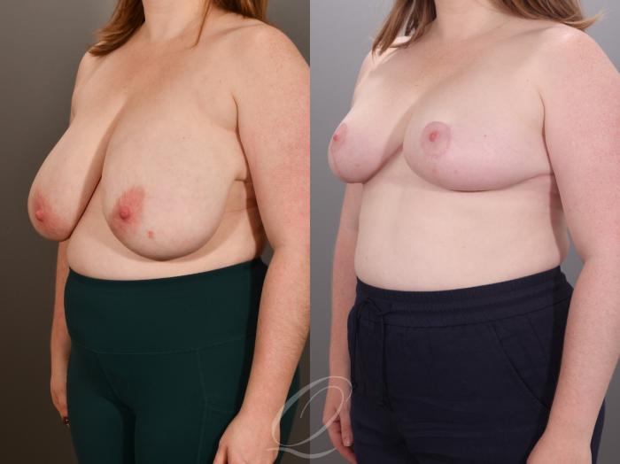 Breast Reduction Case 1001952 Before & After Left Oblique | Serving Rochester, Syracuse & Buffalo, NY | Quatela Center for Plastic Surgery