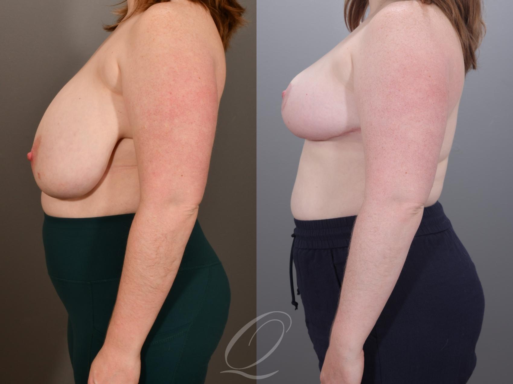 Breast Reduction Case 1001952 Before & After Left Side | Serving Rochester, Syracuse & Buffalo, NY | Quatela Center for Plastic Surgery