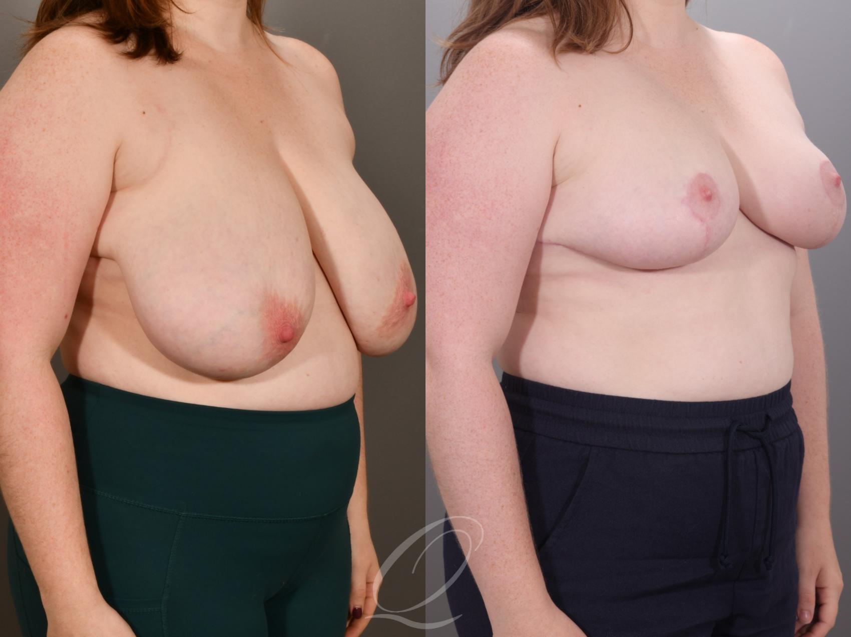 Breast Reduction Case 1001952 Before & After Right Oblique | Serving Rochester, Syracuse & Buffalo, NY | Quatela Center for Plastic Surgery