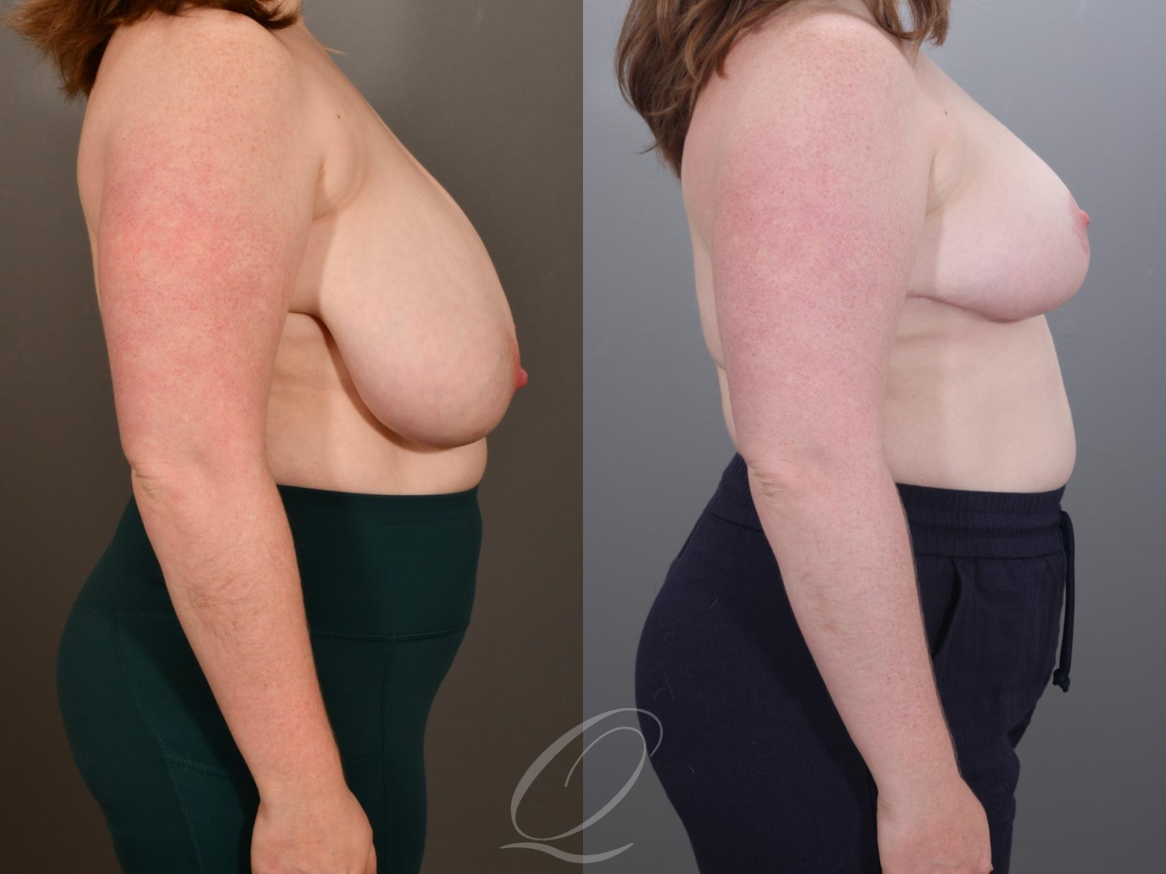 Breast Reduction Case 1001952 Before & After Right Side | Serving Rochester, Syracuse & Buffalo, NY | Quatela Center for Plastic Surgery