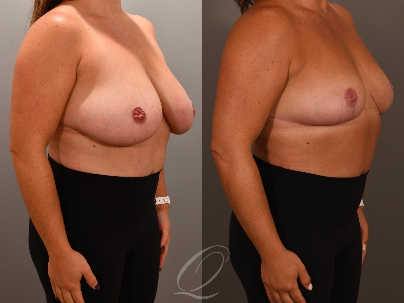 Breast Reduction Case 1001956 Before & After Left Oblique | Serving Rochester, Syracuse & Buffalo, NY | Quatela Center for Plastic Surgery