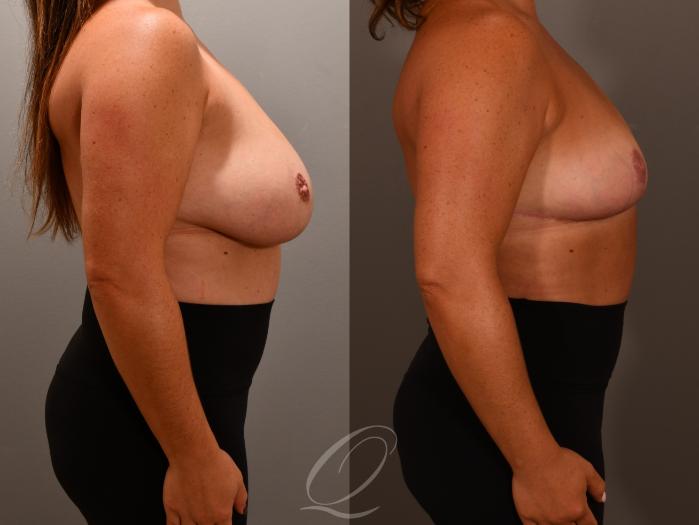 Breast Reduction Case 1001956 Before & After Left Side | Serving Rochester, Syracuse & Buffalo, NY | Quatela Center for Plastic Surgery