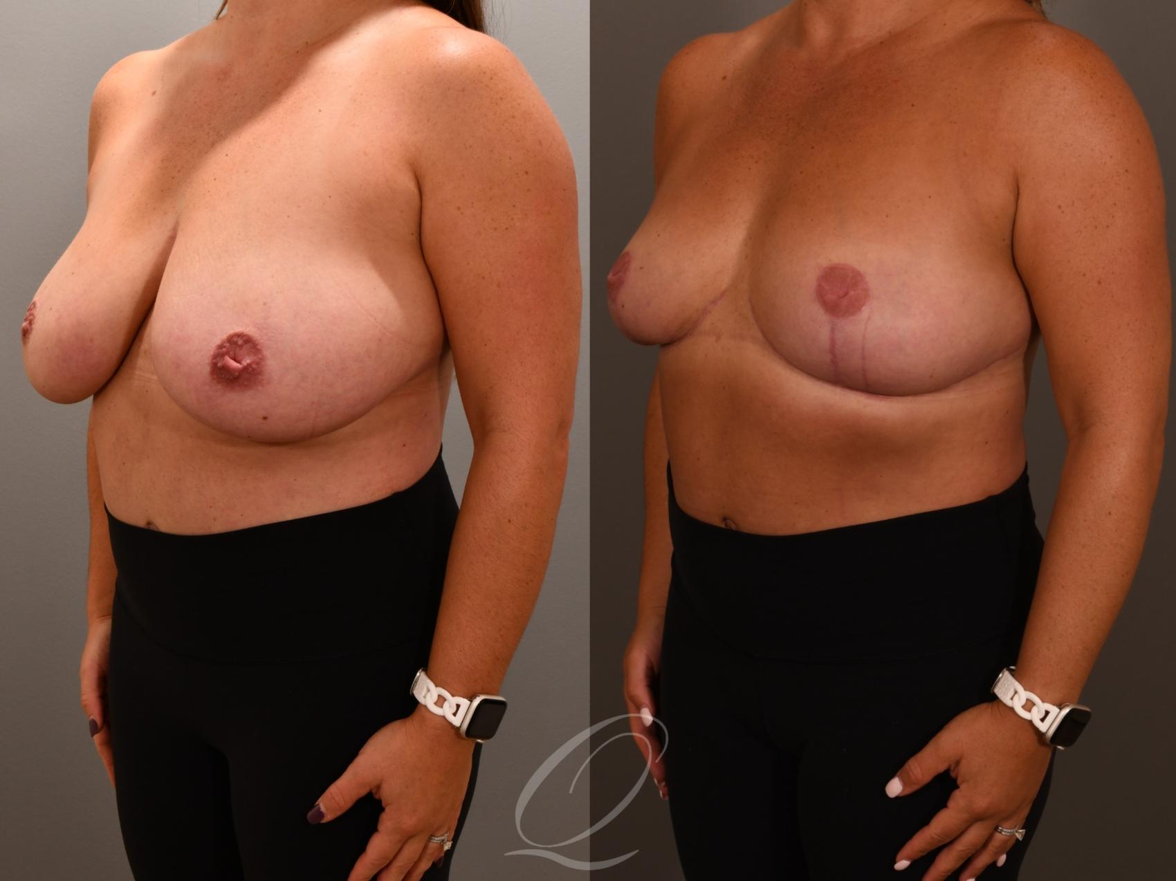 Breast Reduction Case 1001956 Before & After Right Oblique | Serving Rochester, Syracuse & Buffalo, NY | Quatela Center for Plastic Surgery