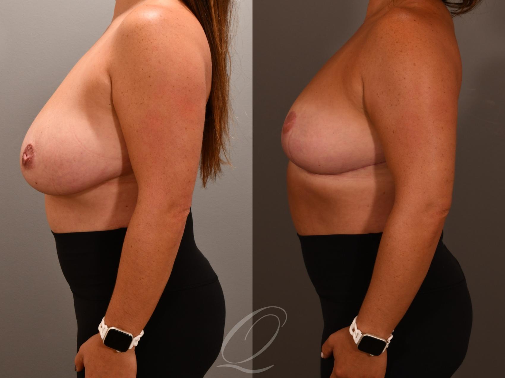 Breast Reduction Case 1001956 Before & After Right Side | Serving Rochester, Syracuse & Buffalo, NY | Quatela Center for Plastic Surgery