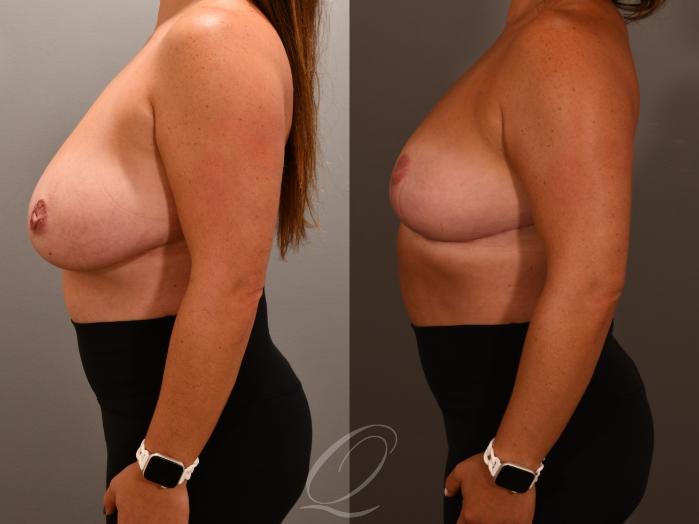 Breast Reduction Case 1001956 Before & After Right Side | Serving Rochester, Syracuse & Buffalo, NY | Quatela Center for Plastic Surgery
