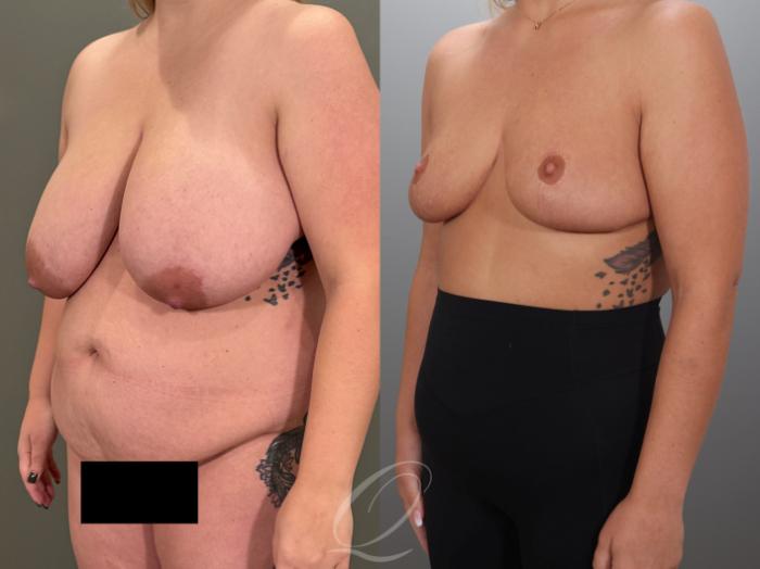 Breast Reduction Case 1001989 Before & After Left Oblique | Serving Rochester, Syracuse & Buffalo, NY | Quatela Center for Plastic Surgery