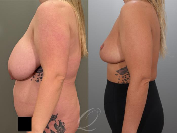 Breast Reduction Case 1001989 Before & After Left Side | Serving Rochester, Syracuse & Buffalo, NY | Quatela Center for Plastic Surgery
