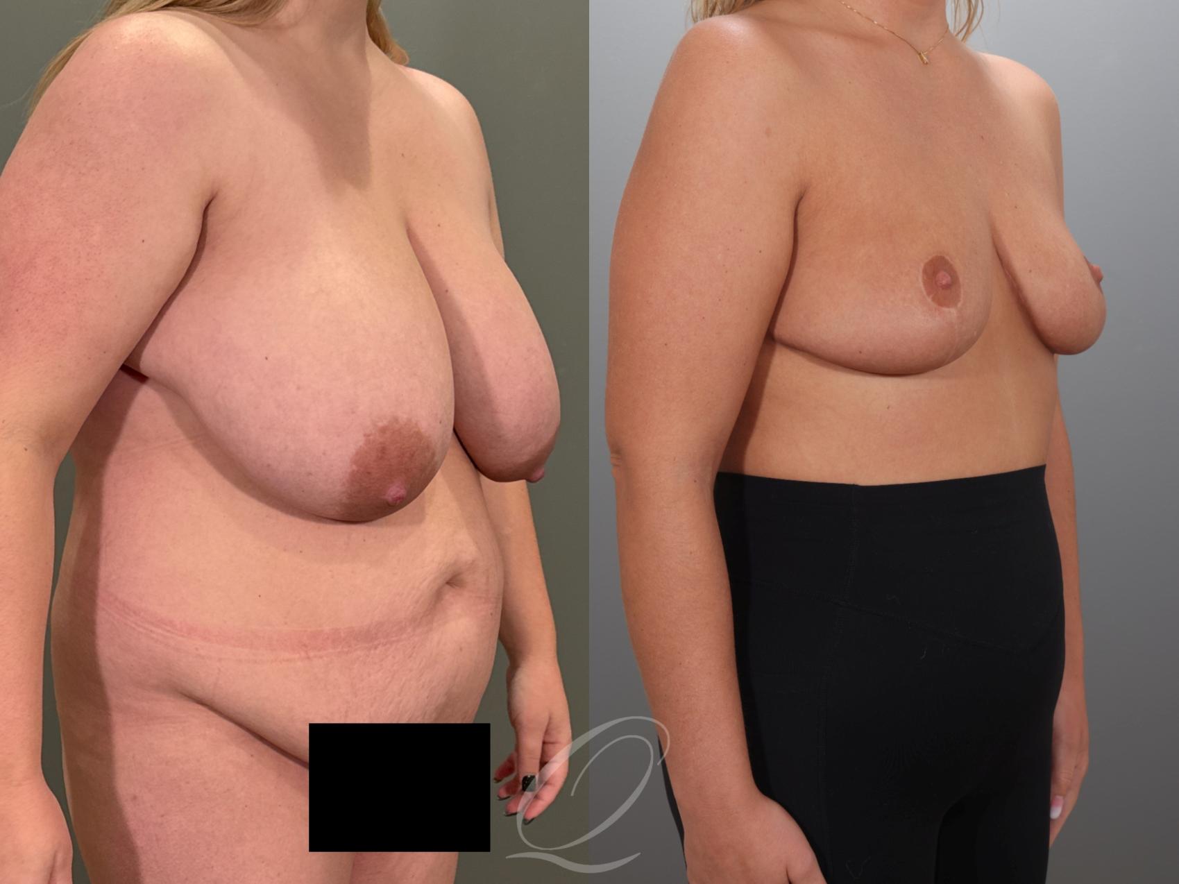 Breast Reduction Case 1001989 Before & After Right Oblique | Serving Rochester, Syracuse & Buffalo, NY | Quatela Center for Plastic Surgery