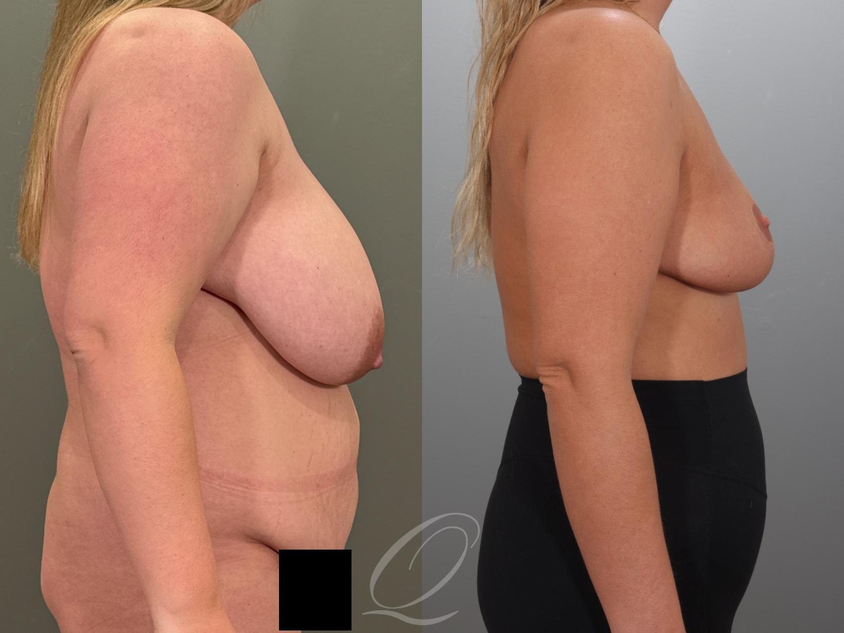 Breast Reduction Case 1001989 Before & After Right Side | Serving Rochester, Syracuse & Buffalo, NY | Quatela Center for Plastic Surgery