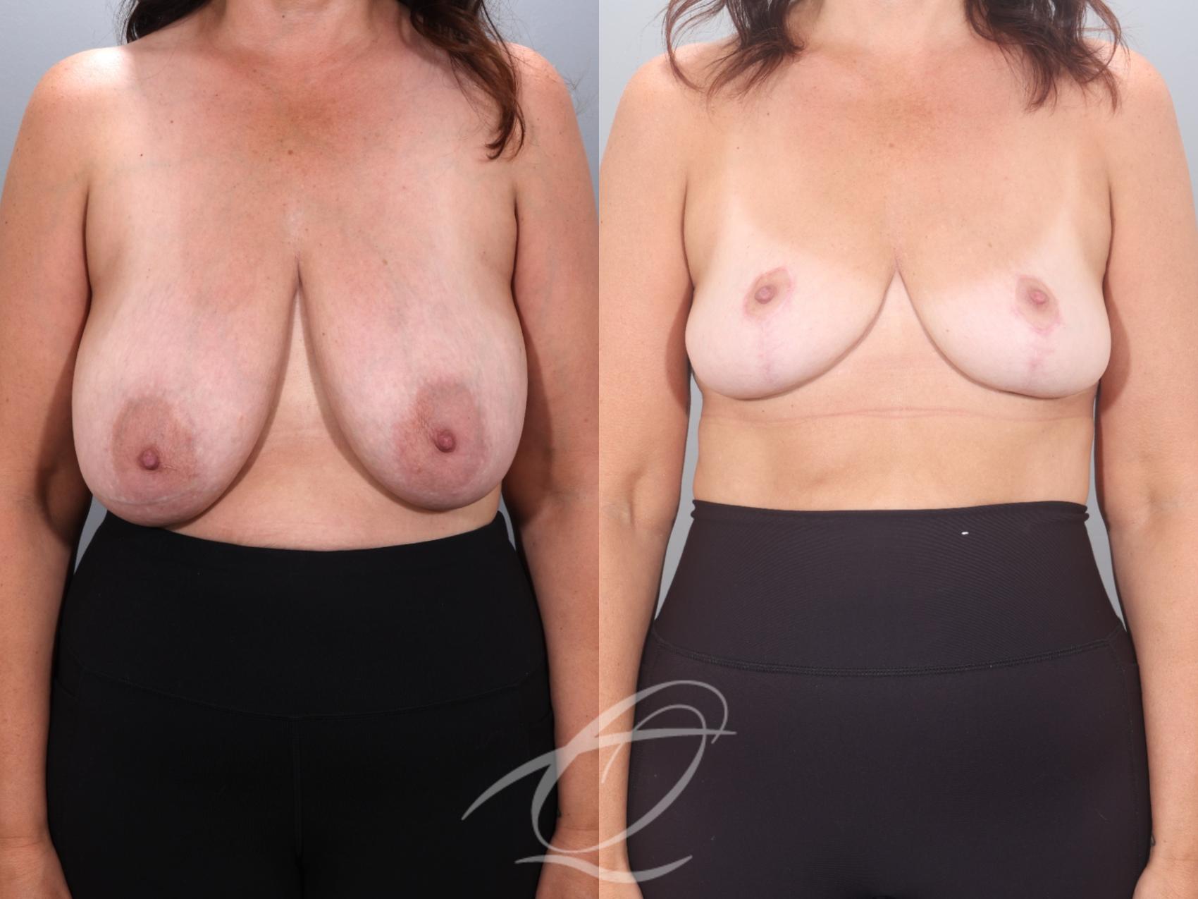 Breast Reduction Case 1002035 Before & After Front | Serving Rochester, Syracuse & Buffalo, NY | Quatela Center for Plastic Surgery