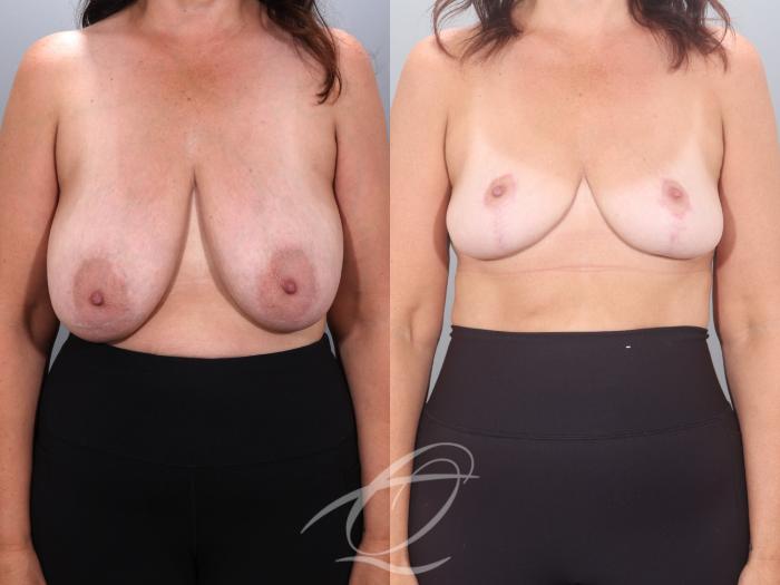 Breast Reduction Case 1002035 Before & After Front | Serving Rochester, Syracuse & Buffalo, NY | Quatela Center for Plastic Surgery