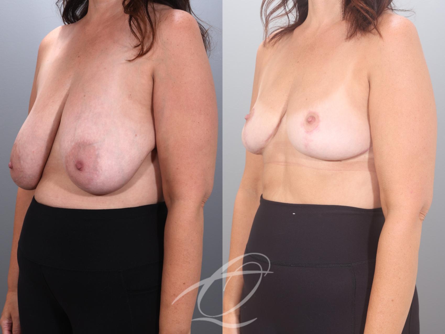 Breast Reduction Case 1002035 Before & After Left Oblique | Serving Rochester, Syracuse & Buffalo, NY | Quatela Center for Plastic Surgery