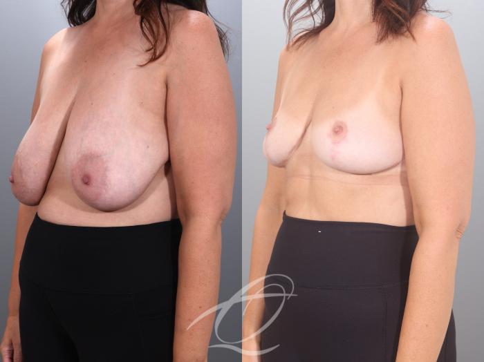 Breast Reduction Case 1002035 Before & After Left Oblique | Serving Rochester, Syracuse & Buffalo, NY | Quatela Center for Plastic Surgery