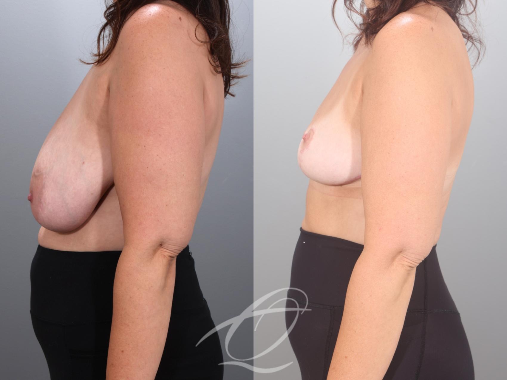 Breast Reduction Case 1002035 Before & After Left Side | Serving Rochester, Syracuse & Buffalo, NY | Quatela Center for Plastic Surgery