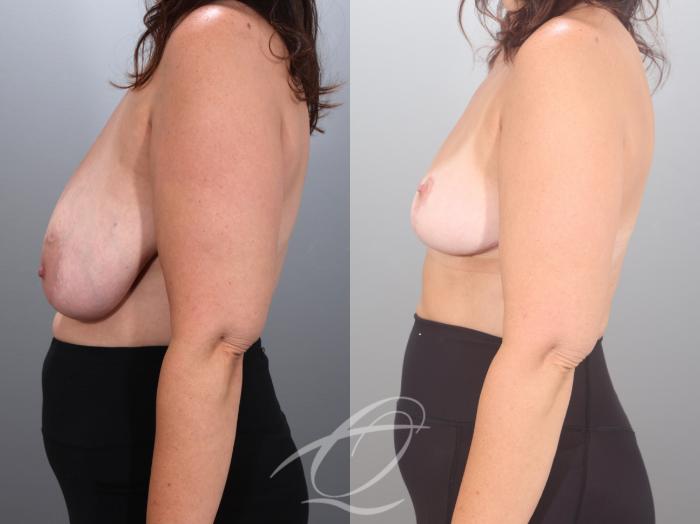 Breast Reduction Case 1002035 Before & After Left Side | Serving Rochester, Syracuse & Buffalo, NY | Quatela Center for Plastic Surgery