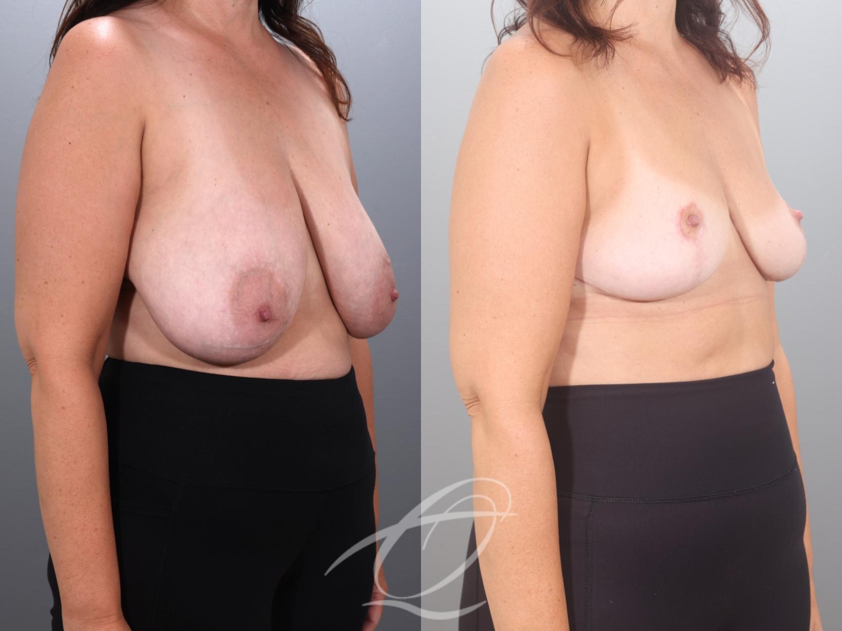 Breast Reduction Case 1002035 Before & After Right Oblique | Serving Rochester, Syracuse & Buffalo, NY | Quatela Center for Plastic Surgery