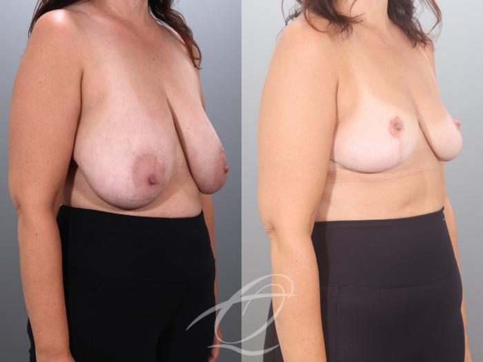 Breast Reduction Case 1002035 Before & After Right Oblique | Serving Rochester, Syracuse & Buffalo, NY | Quatela Center for Plastic Surgery