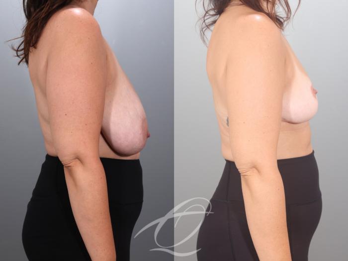 Breast Reduction Case 1002035 Before & After Right Side | Serving Rochester, Syracuse & Buffalo, NY | Quatela Center for Plastic Surgery