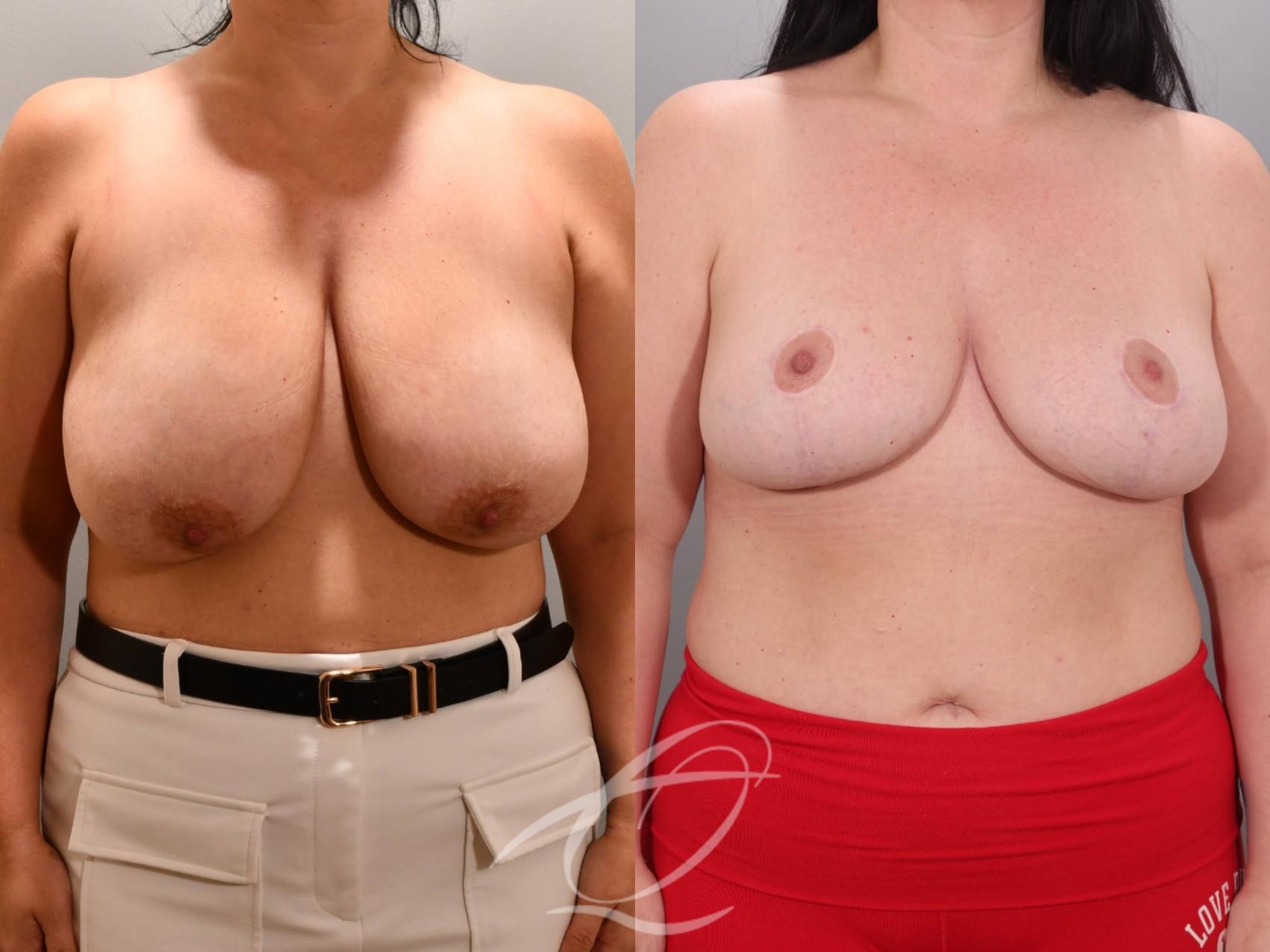 Breast Reduction Case 1002060 Before & After Front | Serving Rochester, Syracuse & Buffalo, NY | Quatela Center for Plastic Surgery